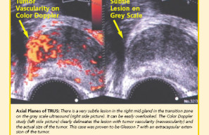 Prostate ultrasound and biopsy