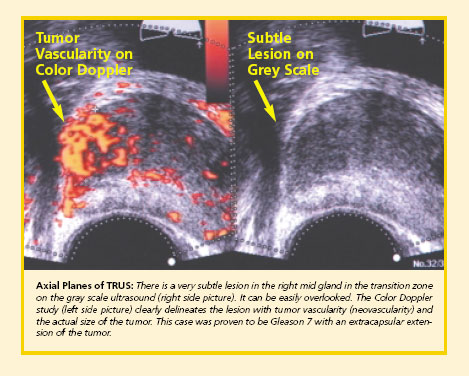 Prostate ultrasound and biopsy
