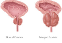 Enlarged prostate treatment