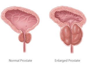 Enlarged prostate treatment