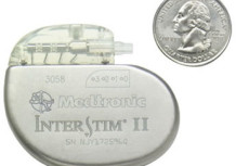 InterStim nerve stimulator for incontinence