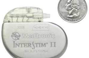 InterStim nerve stimulator for incontinence
