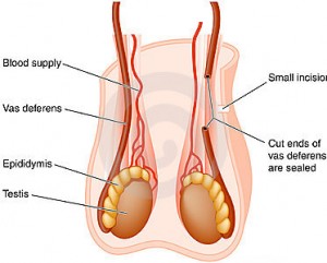 Vasectomy